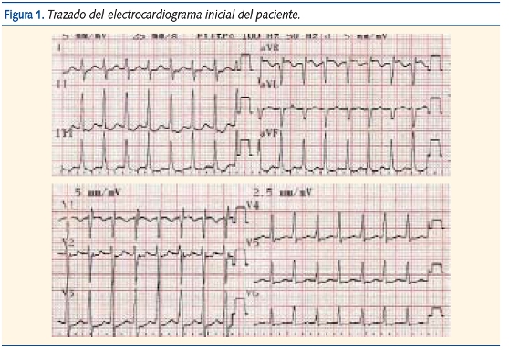 Figura 1. Trazado del electrocardiograma inicial del paciente.